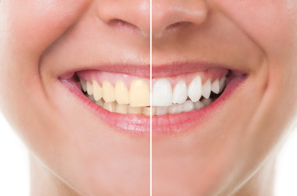 Before and after photo of teeth whitening treatment in Upland