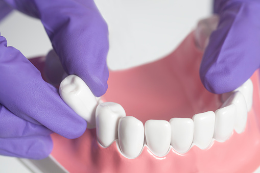 Why Do Some Teeth Need a Surgical Extraction?