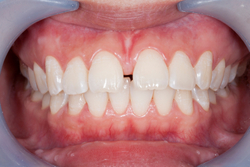 Close-up of white unstained teeth with a gap at Higher Ground Dentistry