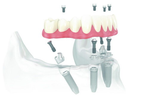 Diagram of All-on-4 Treatment Concept