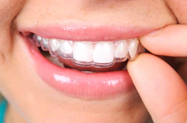 Woman using invisalign clear aligner from our Upland dentist