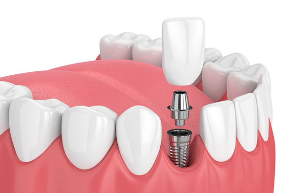 Rendering of jaw with dental implant from Upland California