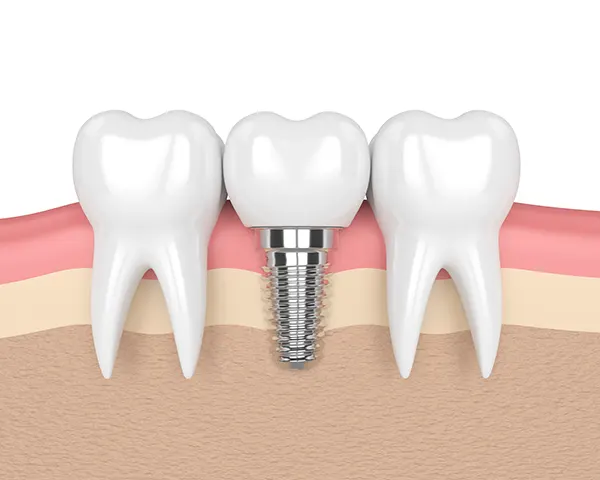 3D rendered cross-section view of a dental implant placed in the jaw between two healthy teeth.