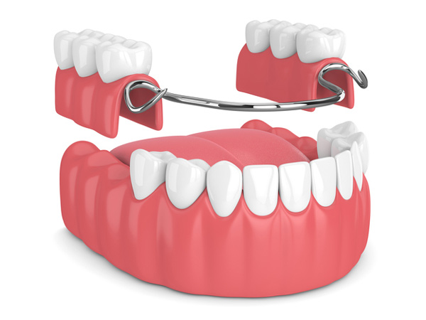 Rendering of removable partial denture from our dentist in Upland