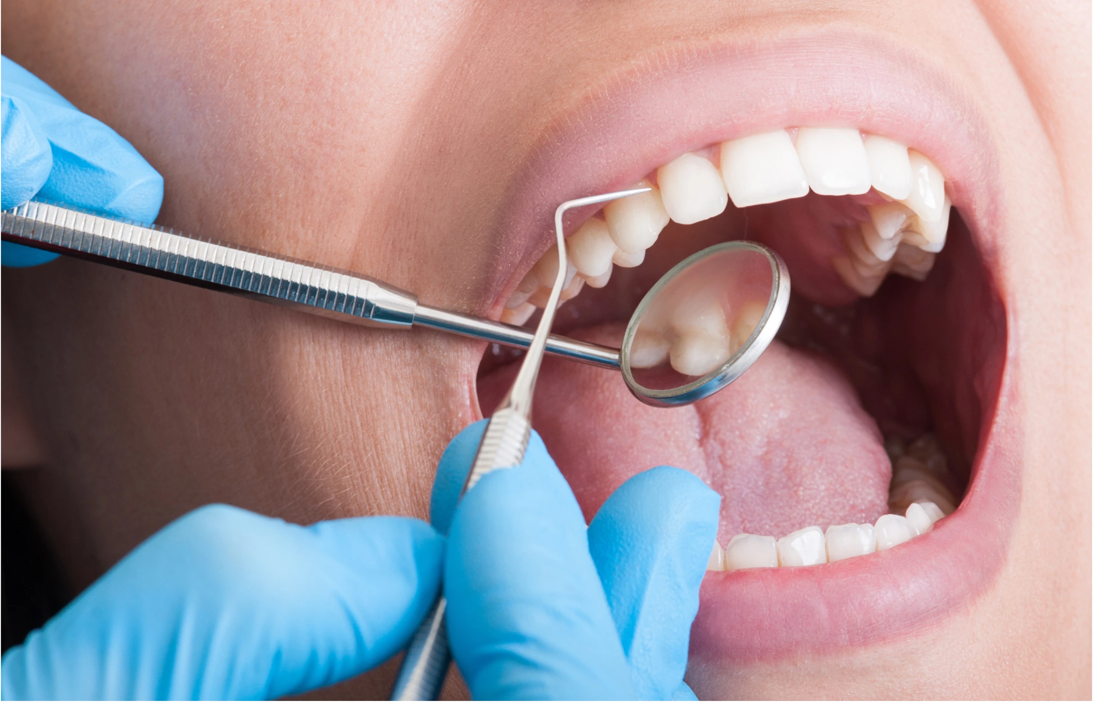 Close-up of patient receiving professional teeth cleaning with dentist wearing blue gloves using dental mirror and scaler