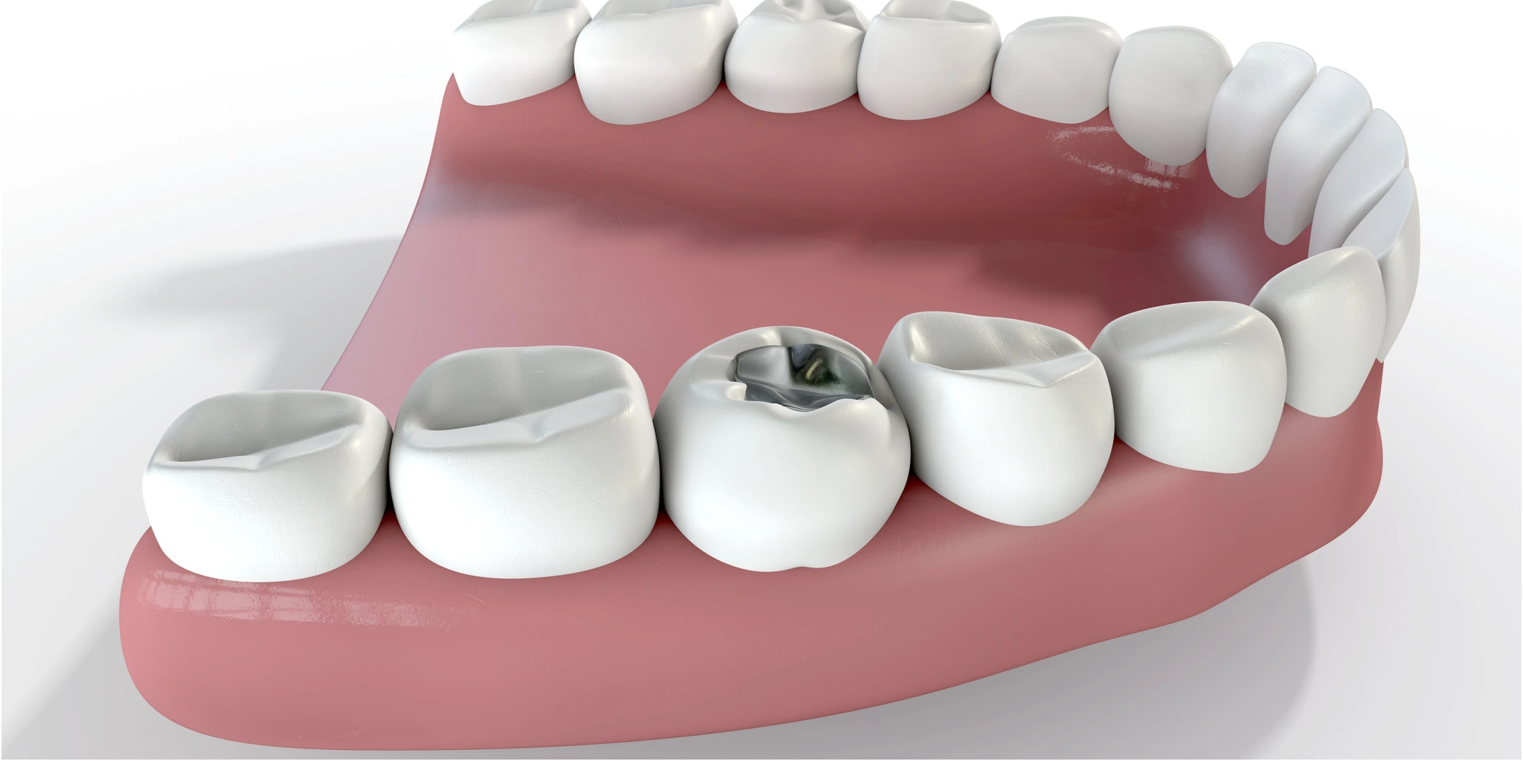 3D illustration of dental filling being placed in molar tooth showing metal filling material