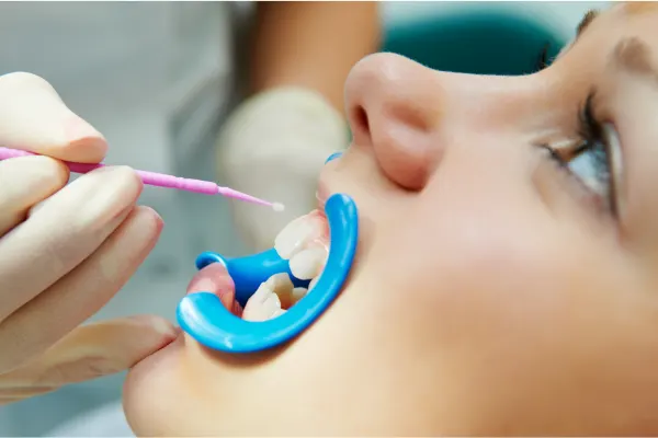 A close-up of a person at the dentist, mouth open with a blue plastic retractor, as a dental professional applies treatment to their teeth using a small brush.