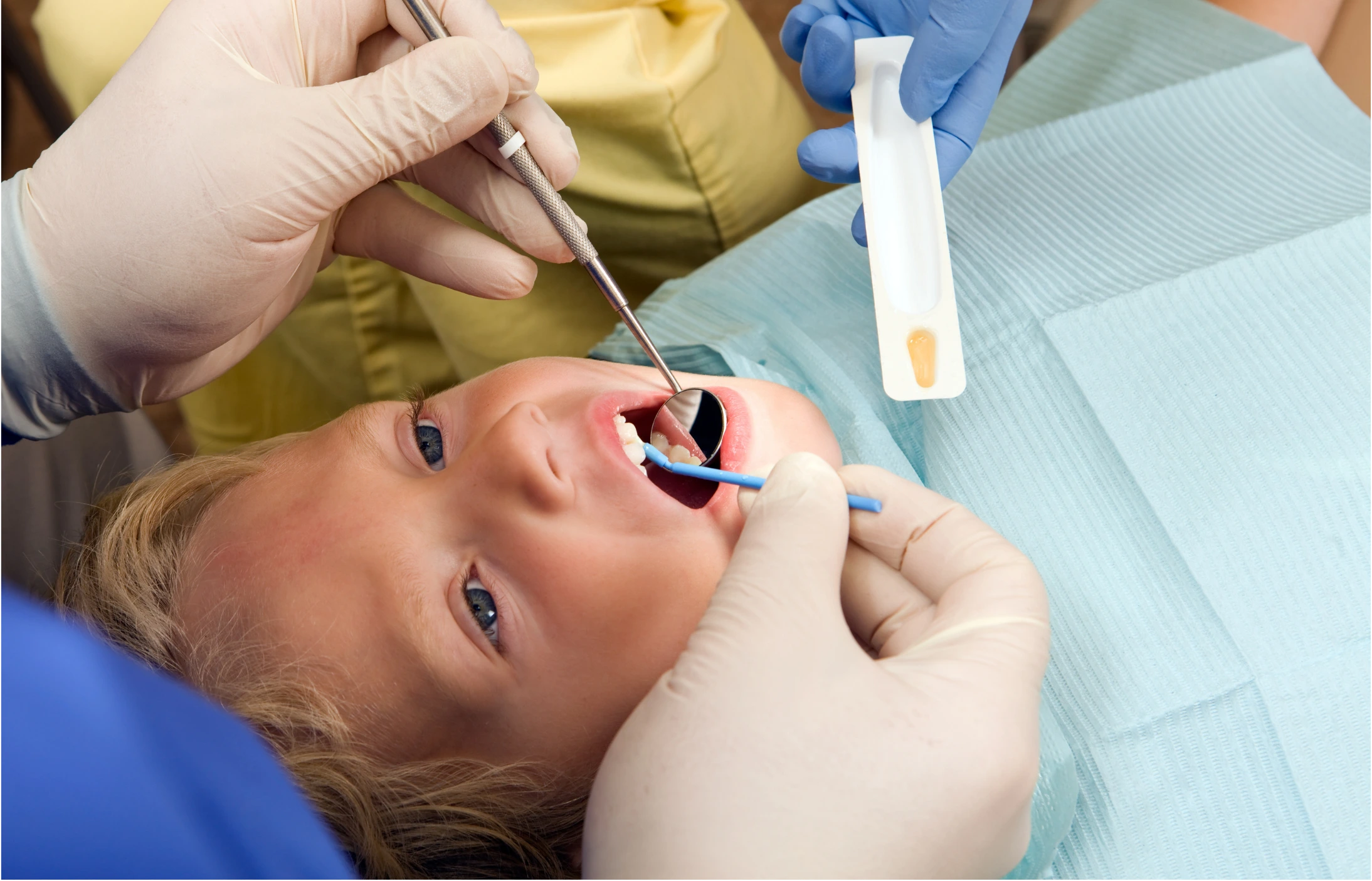 Close-up of child receiving fluoride treatment with dentist applying fluoride to teeth using applicator