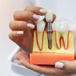 1. SEO-Optimized Alt Text (124 characters) Dentist holding tooth implant model showing root structure - dentures vs dental implants education Higher Ground Dentistry
