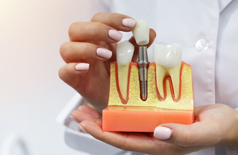 1. SEO-Optimized Alt Text (124 characters) Dentist holding tooth implant model showing root structure - dentures vs dental implants education Higher Ground Dentistry