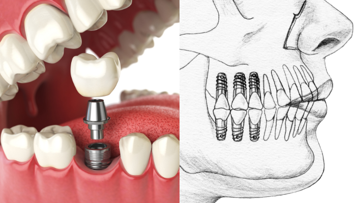 Dental implant placement diagram showing titanium posts - dentures vs dental implants at Higher Ground Dentistry