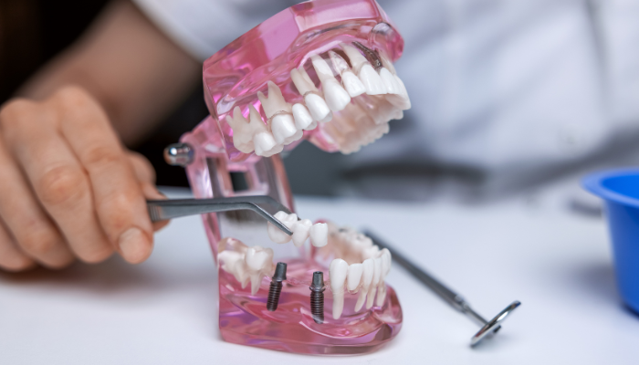 Clear dental model showing dental implants and natural teeth demonstrating dental implant recovery stages