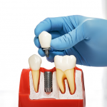 Dental professional placing dental implant crown on model showing proper dental implant recovery procedure
