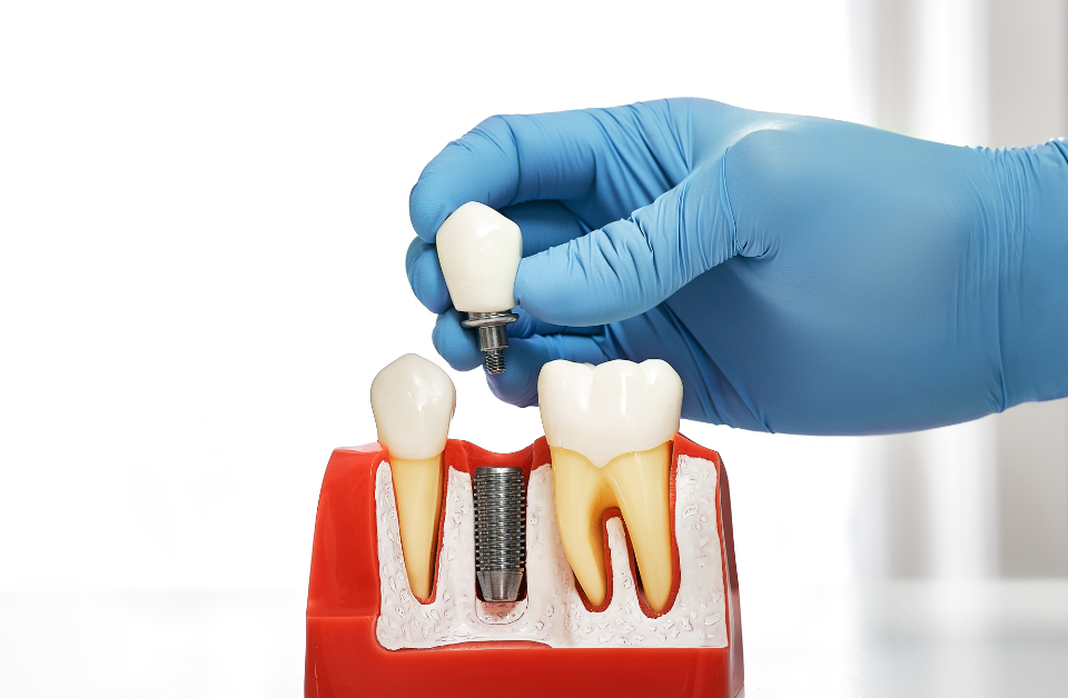 Dental professional placing dental implant crown on model showing proper dental implant recovery procedure