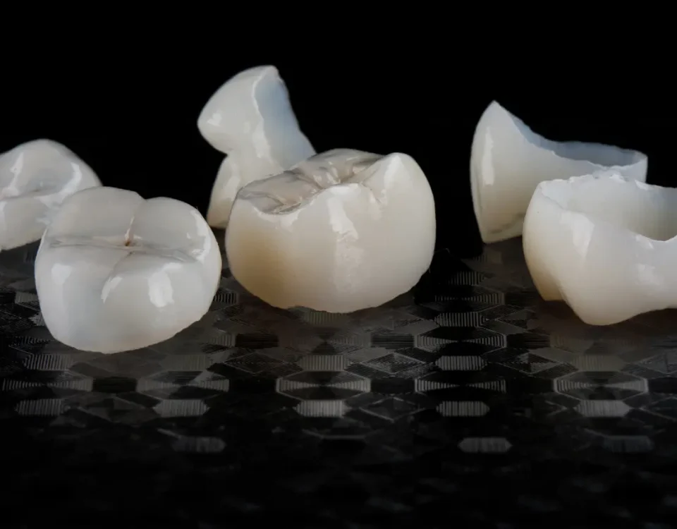 Dental crowns that fell off shown separately from teeth demonstrating crown emergency