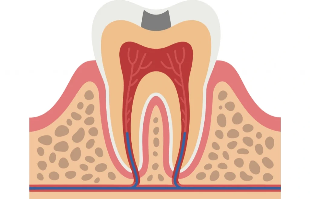 Cross-section of tooth showing dental filling failure with decay underneath causing damage to tooth structure