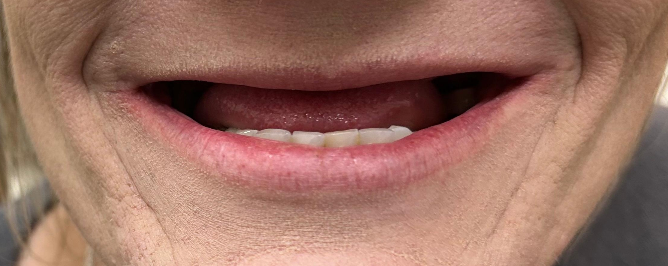 Missing tooth requiring dental implant replacement at Higher Ground Dentistry Upland California