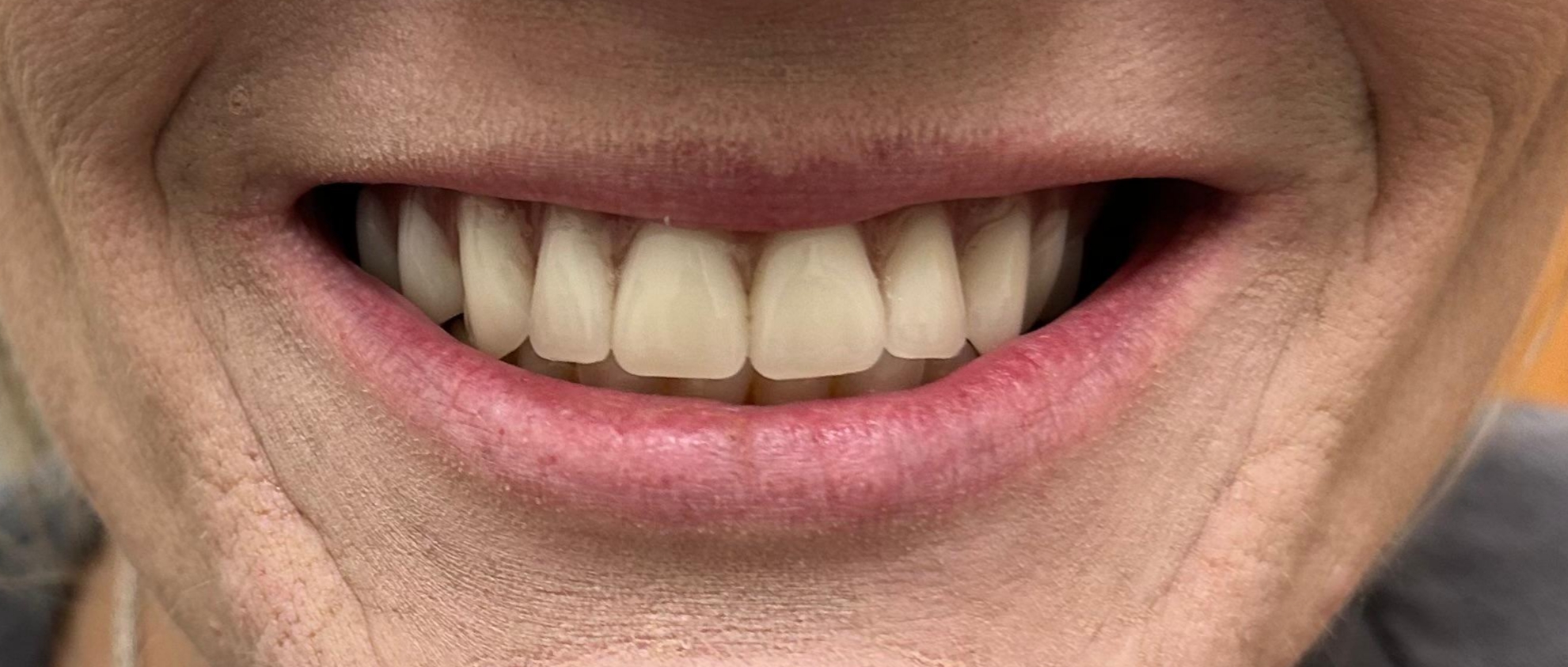 Complete smile restoration with dental implants at Higher Ground Dentistry Upland California natural results