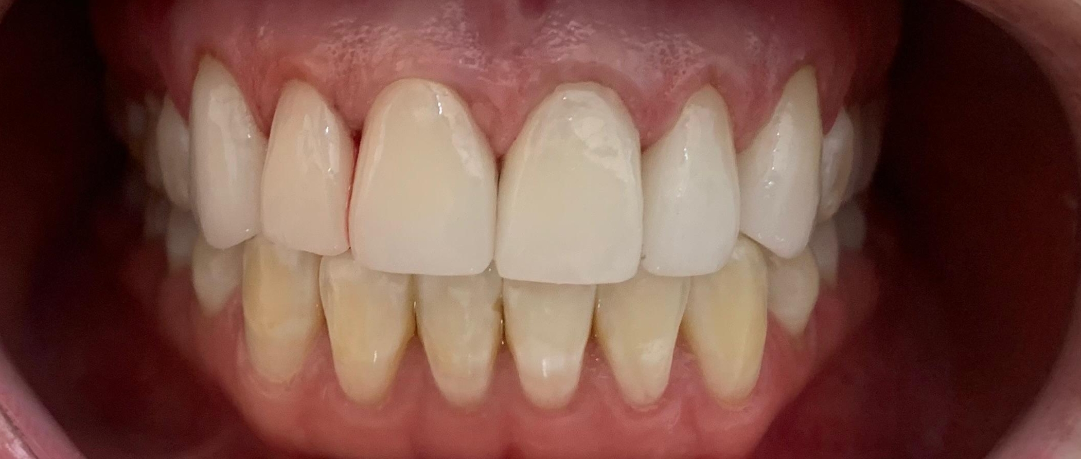 A close-up photo of a person’s teeth and gums, showing both upper and lower teeth. The upper teeth appear whiter, while the lower teeth have a more yellowish tint. The mouth is opened wide.