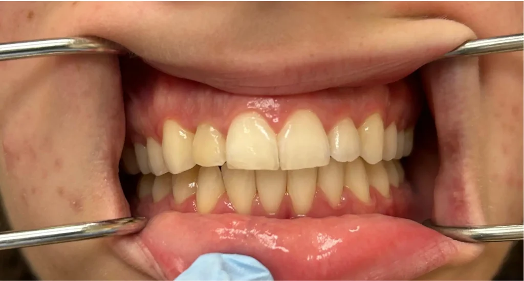 Person's teeth and gums during dental checkup