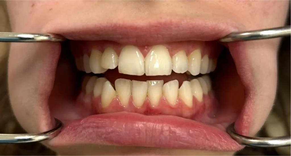aligners before