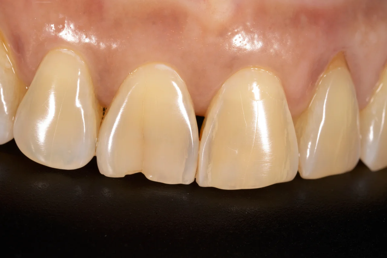 Close-up of front teeth showing cracks and fracture lines on upper incisors