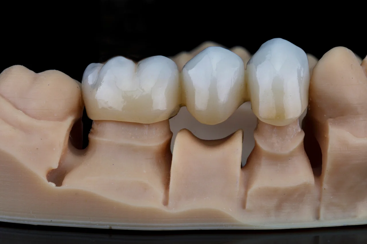 Hand holding dental bridge prosthetic with multiple connected teeth