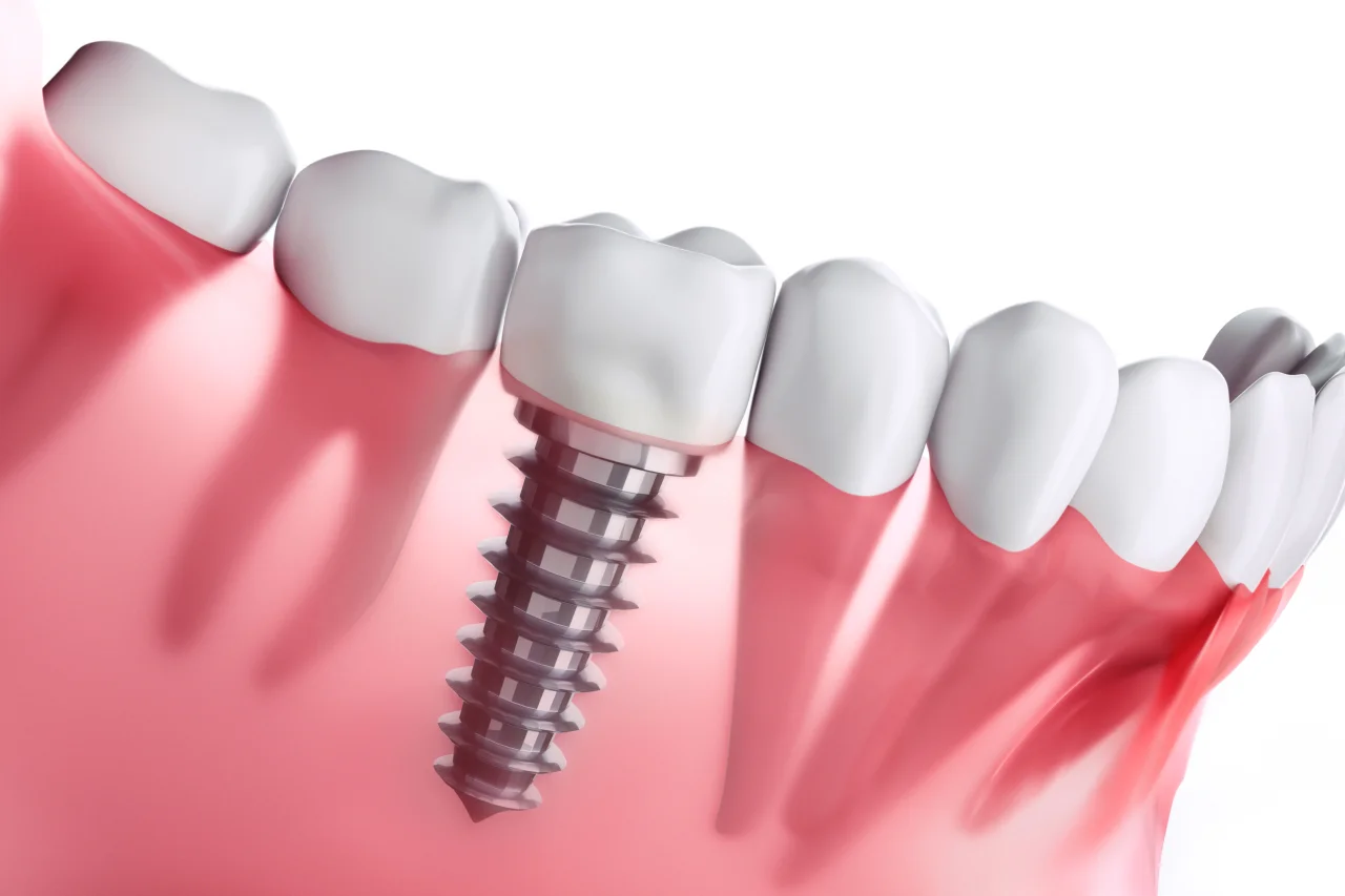3D illustration of dental implant with metal post in gum tissue next to natural teeth