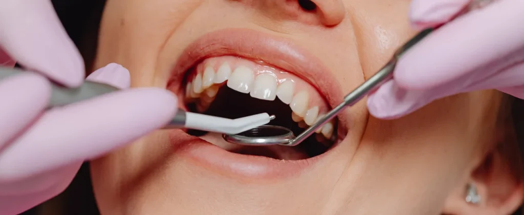 Close-up of patient's mouth during dental examination with dentist wearing pink gloves using dental instruments