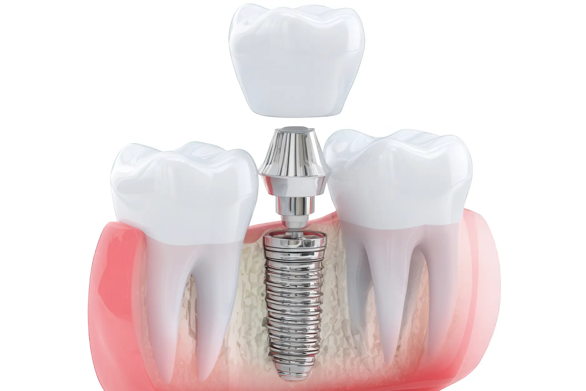 3D illustration of dental implant with metal post and crown between natural teeth in jaw bone