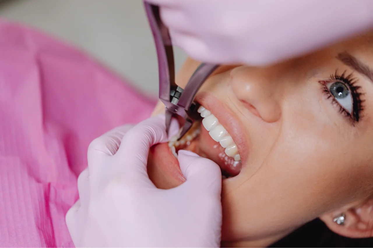 Close-up of dental extraction procedure showing dentist using forceps to remove tooth