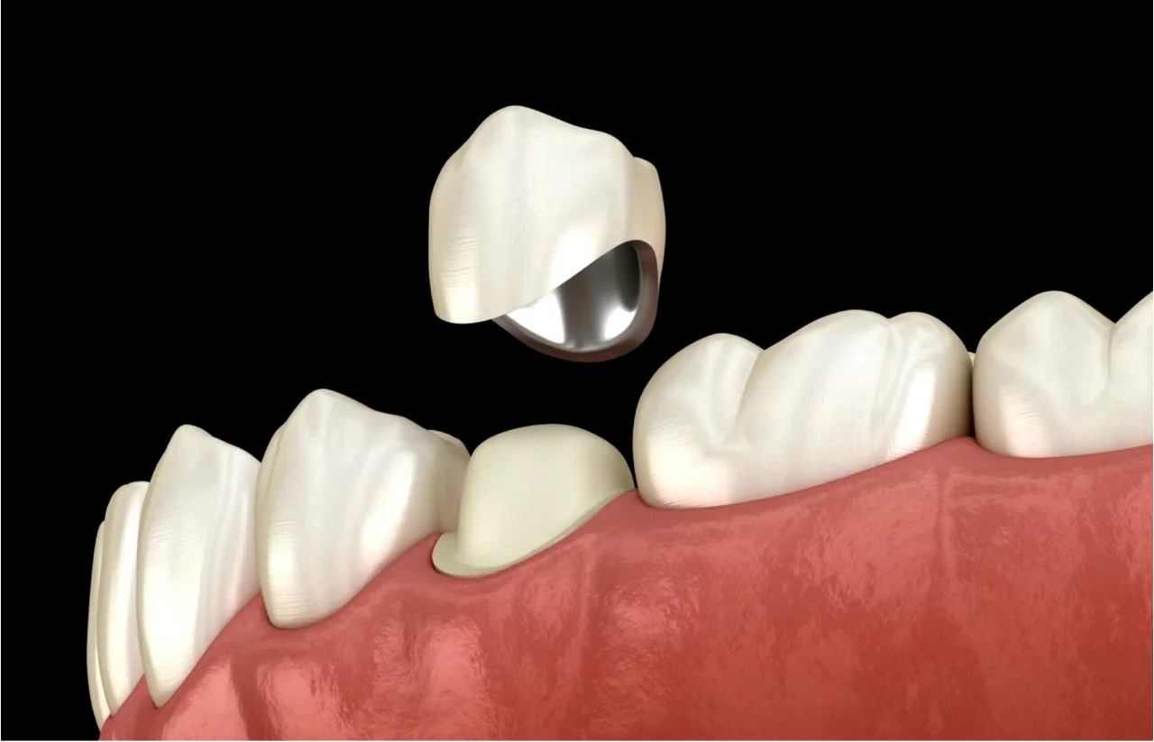 Dental crown being placed on tooth at Higher Ground Dentistry in Upland California