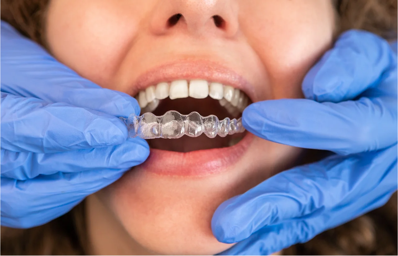 Dentist placing Invisalign clear aligners on patient at Higher Ground Dentistry Upland CA