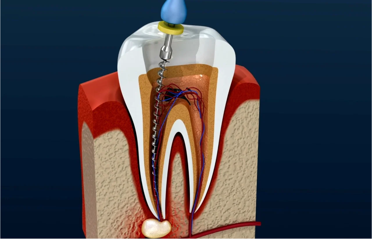 Cross-section illustration of tooth showing root canal procedure at Higher Ground Dentistry Upland CA