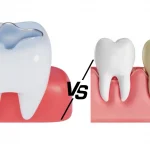 Side-by-side comparison illustration showing a tooth with a dental filling on the left and a tooth with a dental crown on the right, demonstrating the difference between two common restorative dental procedures