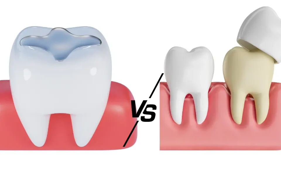 Side-by-side comparison illustration showing a tooth with a dental filling on the left and a tooth with a dental crown on the right, demonstrating the difference between two common restorative dental procedures