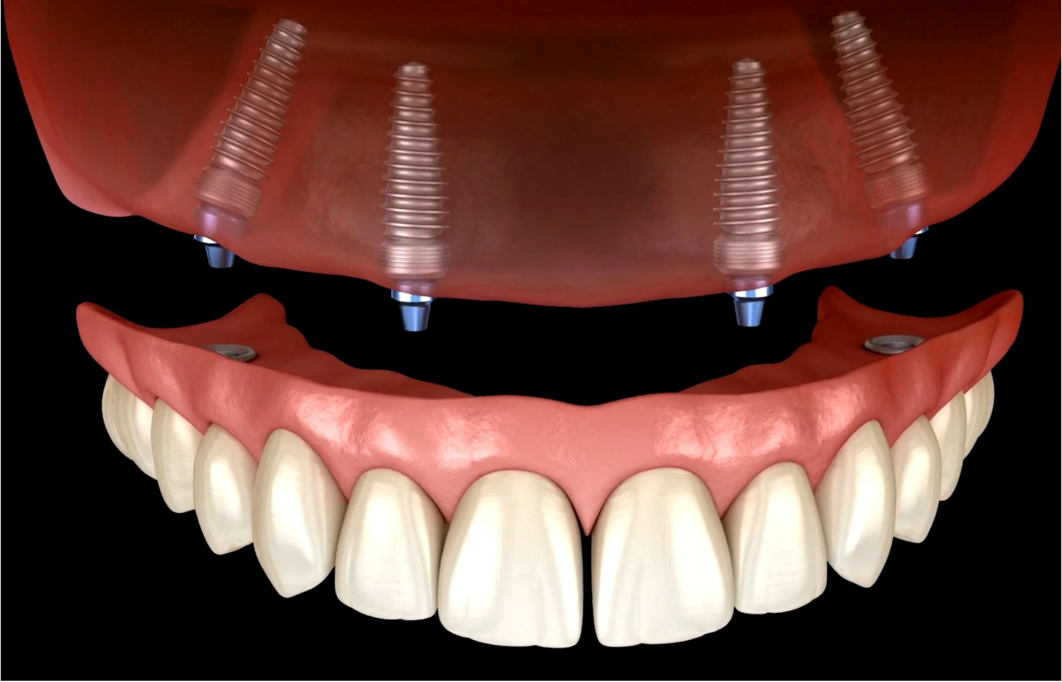 All-on-4 dental implants Upland CA Higher Ground Dentistry Dr Vikas Sikka