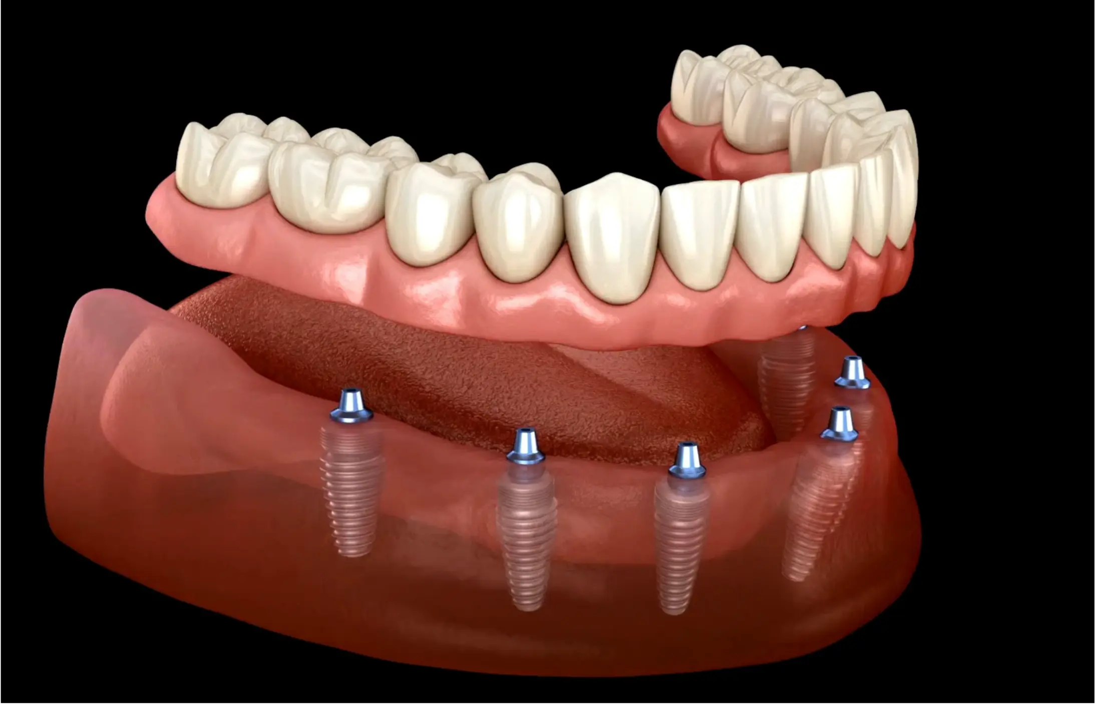 Implant overdenture with titanium implants Upland CA Higher Ground Dentistry