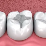 3D illustration of dental fillings in molar teeth showing signs of wear and replacement need at Higher Ground Dentistry Upland CA