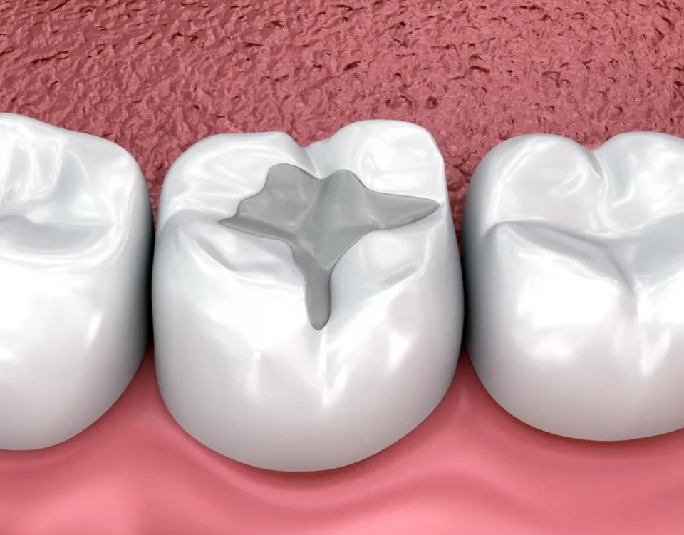 3D illustration of dental fillings in molar teeth showing signs of wear and replacement need at Higher Ground Dentistry Upland CA