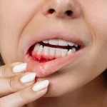Dentist examining red inflamed gums for gum infection treatment at Higher Ground Dentistry in Upland CA