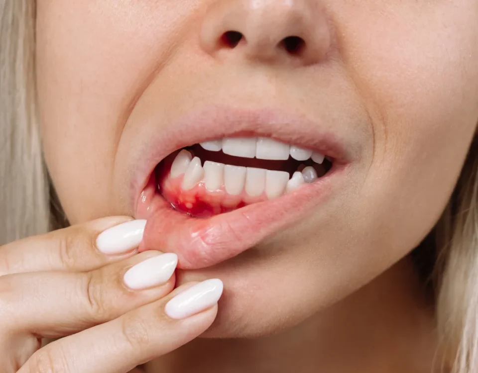 Dentist examining red inflamed gums for gum infection treatment at Higher Ground Dentistry in Upland CA