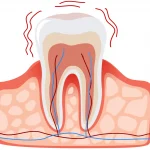 Medical illustration showing sensitive tooth anatomy with exposed nerve endings and dentin hypersensitivity at Higher Ground Dentistry Upland CA