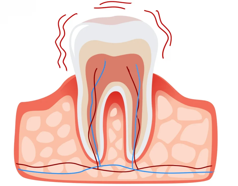 Medical illustration showing sensitive tooth anatomy with exposed nerve endings and dentin hypersensitivity at Higher Ground Dentistry Upland CA