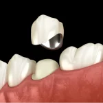 3D illustration of dental crown being placed on tooth representing dental crown upland ca restoration at Higher Ground Dentistry