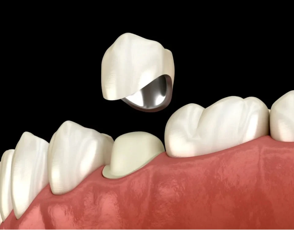 3D illustration of dental crown being placed on tooth representing dental crown upland ca restoration at Higher Ground Dentistry