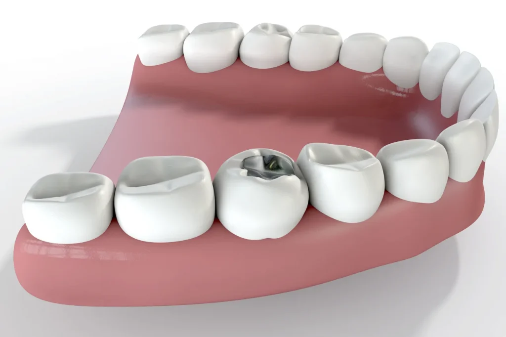 f3D illustration of a dental filling in a molar tooth representing failed filling and dental filling upland ca at Higher Ground Dentistry