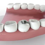 f3D illustration of a dental filling in a molar tooth representing failed filling and dental filling upland ca at Higher Ground Dentistry