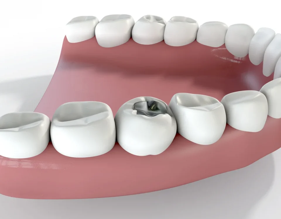 f3D illustration of a dental filling in a molar tooth representing failed filling and dental filling upland ca at Higher Ground Dentistry