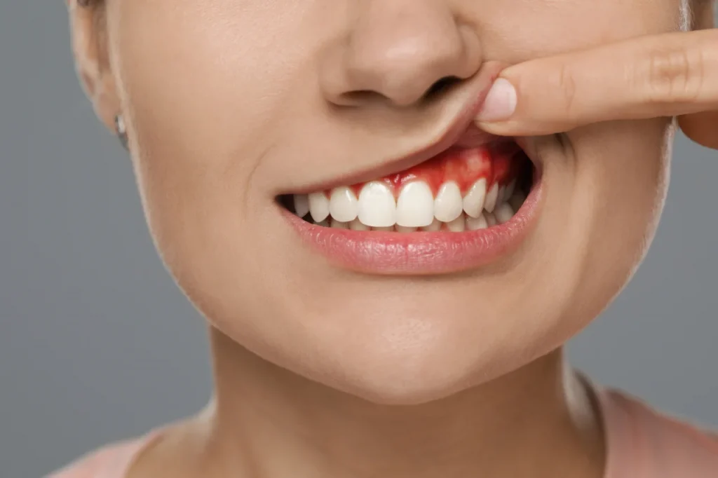 Woman pointing to inflamed red gums showing early signs of gum disease